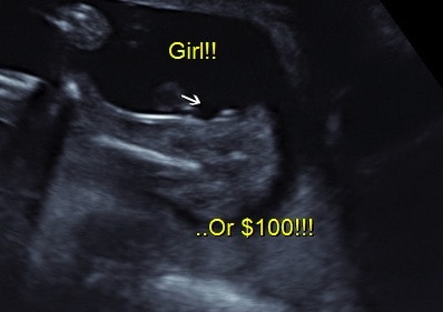 Ultrasound gender determination