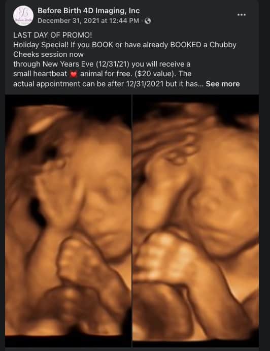 21 weeks ultrasound