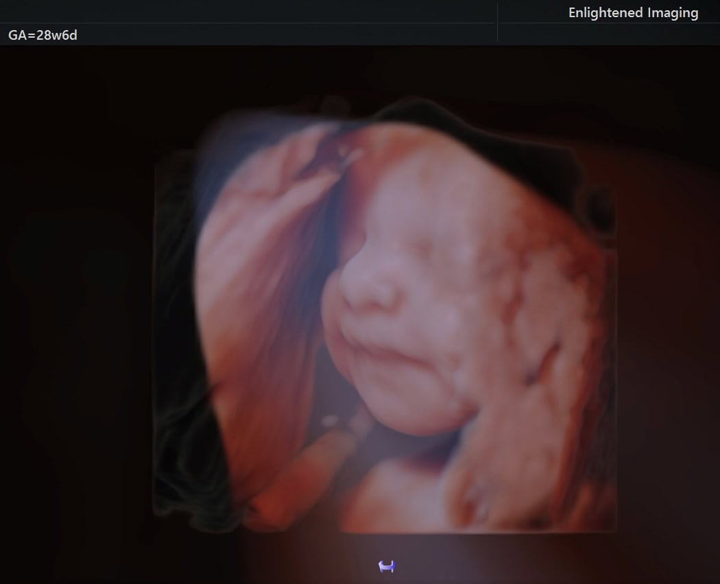 Level 3 ultrasound image example from Enlightened 4D Imaging